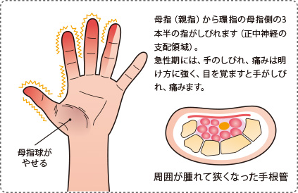 手根管症候群の症状