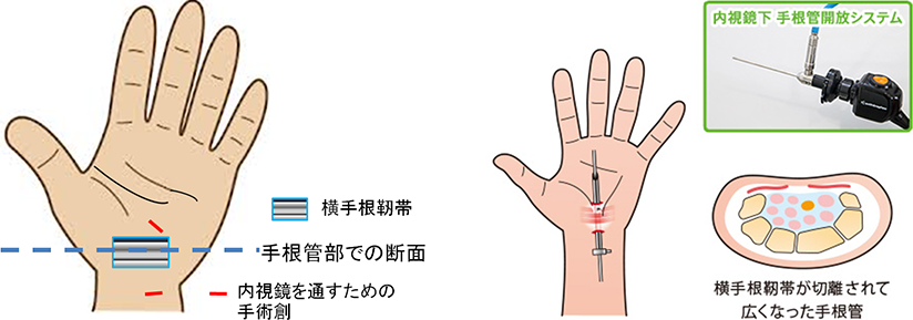 手根管症候群の内視鏡下の日帰り手術 相模大野駅前タワー整形外科 リウマチ科 手根管症候群の内視鏡下の日帰り手術 相模大野駅前タワー整形外科 リウマチ科