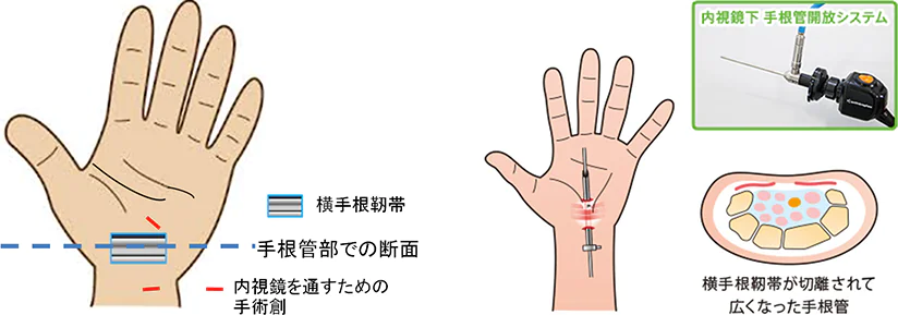 内視鏡下の手根管症候群の日帰り手術