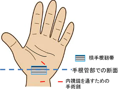 内視鏡下の手根管症候群の日帰り手術