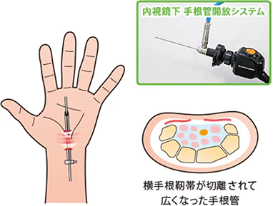 内視鏡下の手根管症候群の日帰り手術