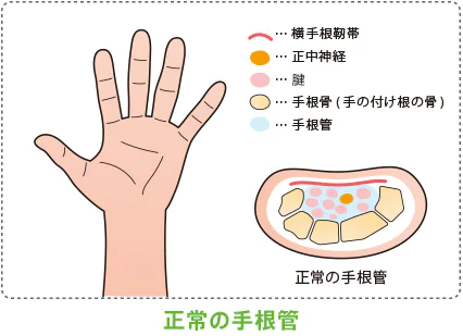 手根管症候群の原因