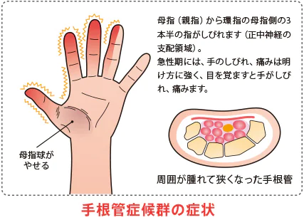 手根管症候群の原因