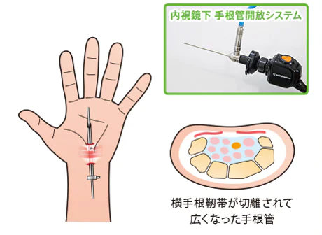 手外科専門医による鏡視下手根管開放術