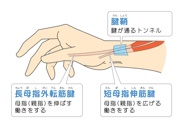 ド・ケルバン腱鞘炎